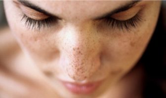 pigmentation