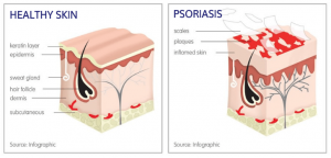 psoriasis