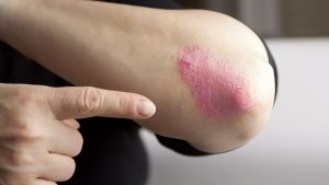 psoriasis
